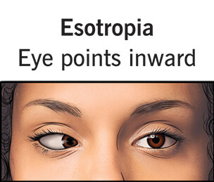 Esotropia-strabismus-eye-misalignment Esotropia-strabismus-eye-misalignment