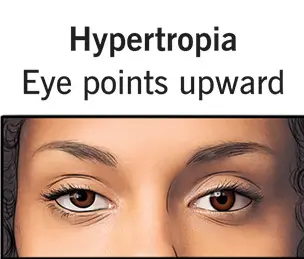 Hypertropia-strabismus-eye-misalignment Hypertropia-strabismus-eye-misalignment
