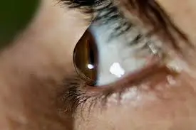 Keratoconus Symptoms