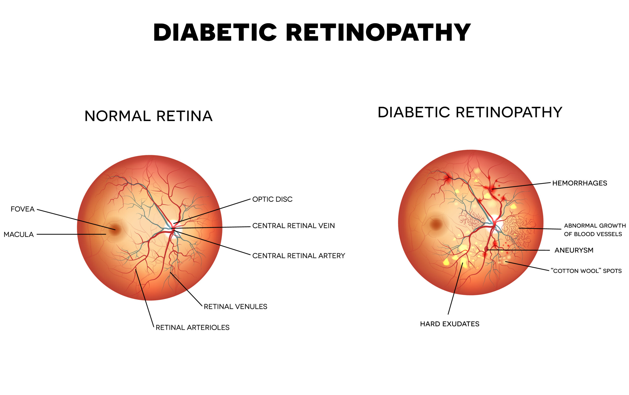Diabetic rethinopathy treatment Johannesburg