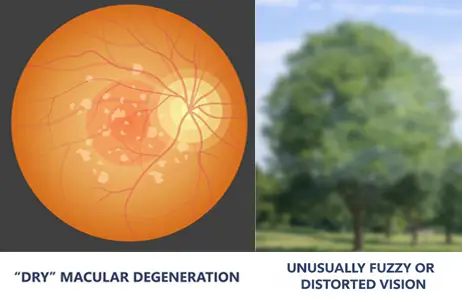 dry macular degeneration