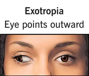 exotropia-strabismus-eye-misalignment exotropia-strabismus-eye-misalignment