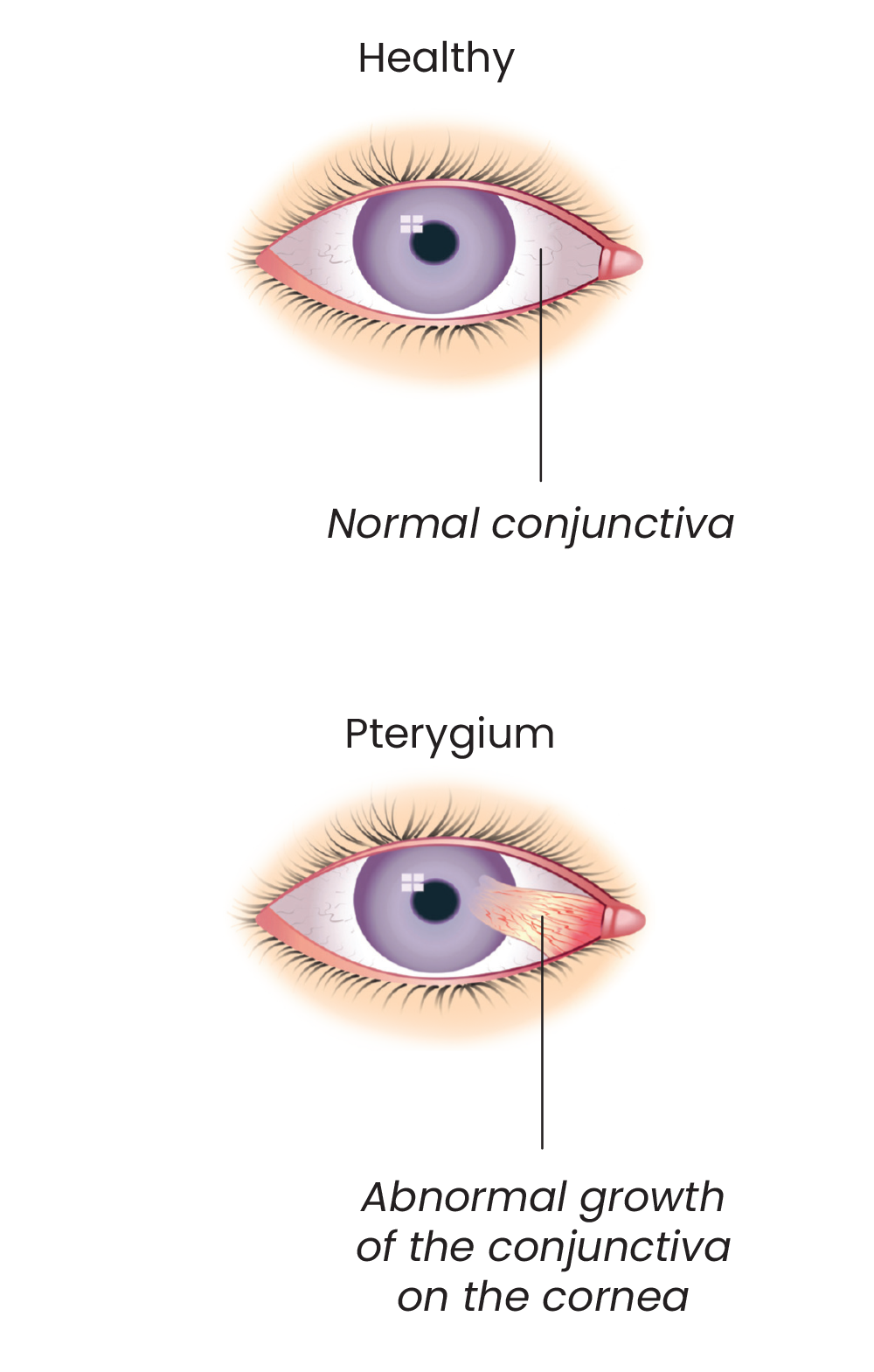 Pterygium-illustration