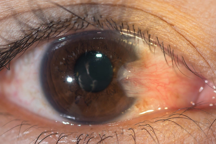 Pterygium and eye with a fleshy growth protruding from inner tear duct Melrose Johannesburg